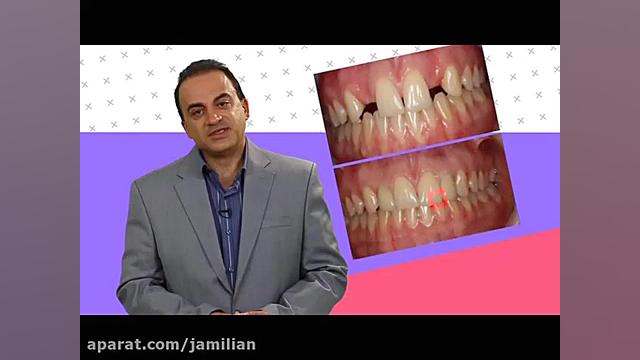 فاصله بین دندان ها و بستن این فاصله با ارتودنسی دکتر عبدالرضا جمیلیان - متخصص ارتودنسی