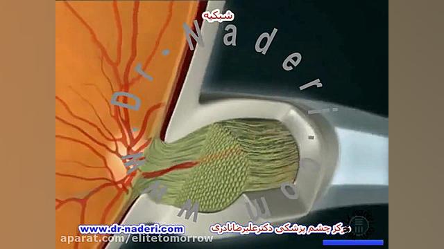 شبکیه -ساختمان چشم- مرکز چشم پزشکی دکتر علیرضا نادری پلاسماجت