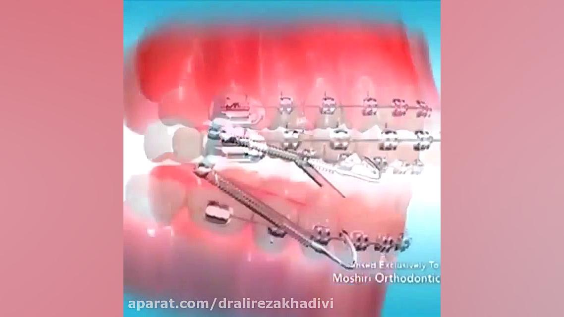 اصلاح فک پایین با ارتودنسی دکتر علیرضا خدیوی