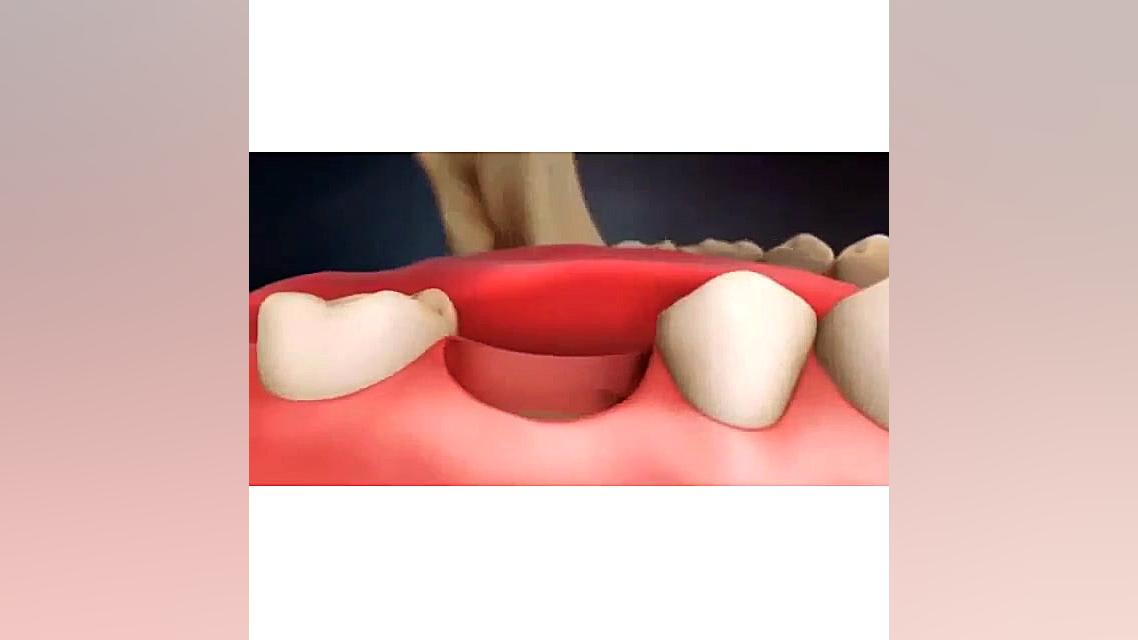 اثرات از دست دادن دندانهای دائمی دکتر علیرضا خدیوی