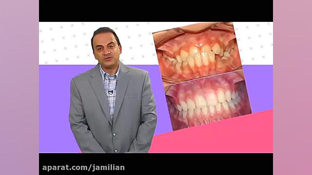 نامرتبی و شلوغی دندان ها دکتر عبدالرضا جمیلیان - متخصص ارتودنسی