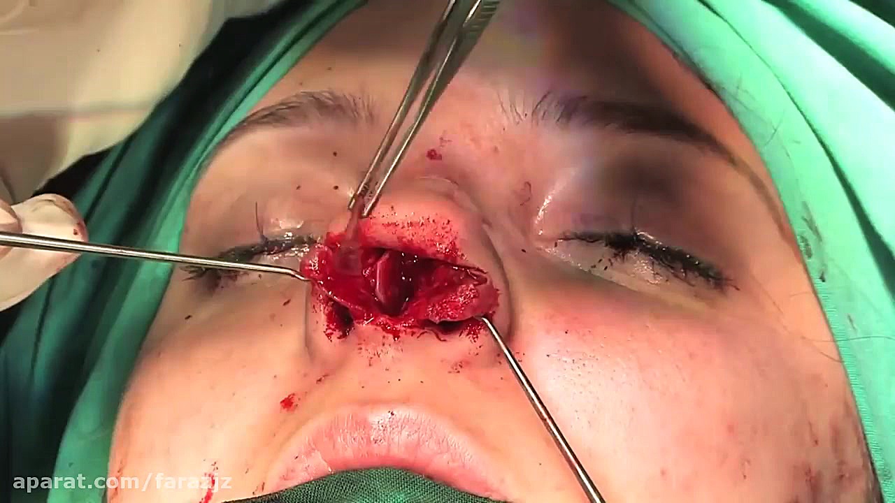 فیلم کامل جراحی زیبایی بینی Nose Plastic Surgery دندان پیش