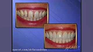 دندانپزشکی زیبایی- باندینگ دکتر فروزان فرسادنیا www.drfarsadniya.ir