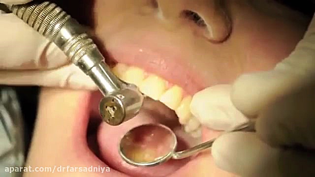 دندانپزشکی زیبایی- باندینگ دکتر فروزان فرسادنیا www.drfarsadniya.ir