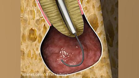 دندانپزشکی- درمان ریشه دکتر فروزان فرسادنیا www.drfarsadniya.ir
