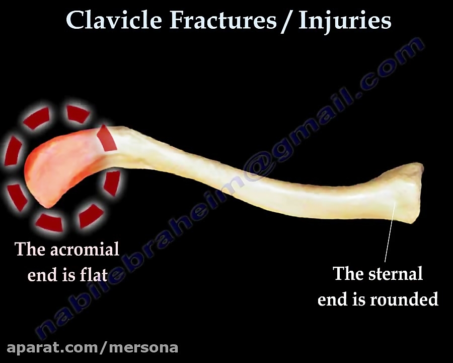 clavicle fracture treatment