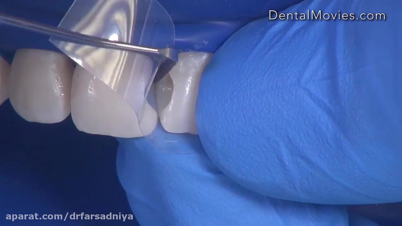 پر کردن دندان- کامپوزیت دکتر فروزان فرسادنیا www.drfarsadniya.ir