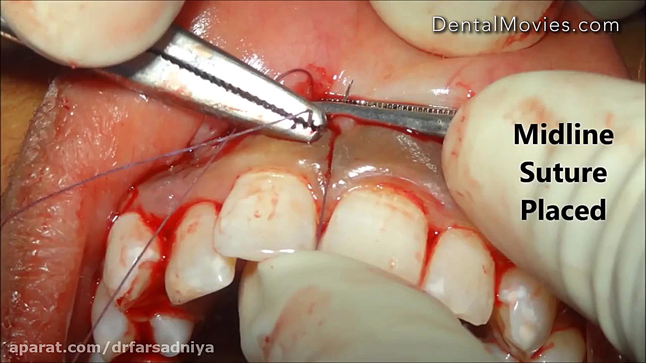 جراحی زیبایی- خط لبخند- ترمیم موضع لب دکتر فروزان فرسادنیا www.drfarsadniya.ir
