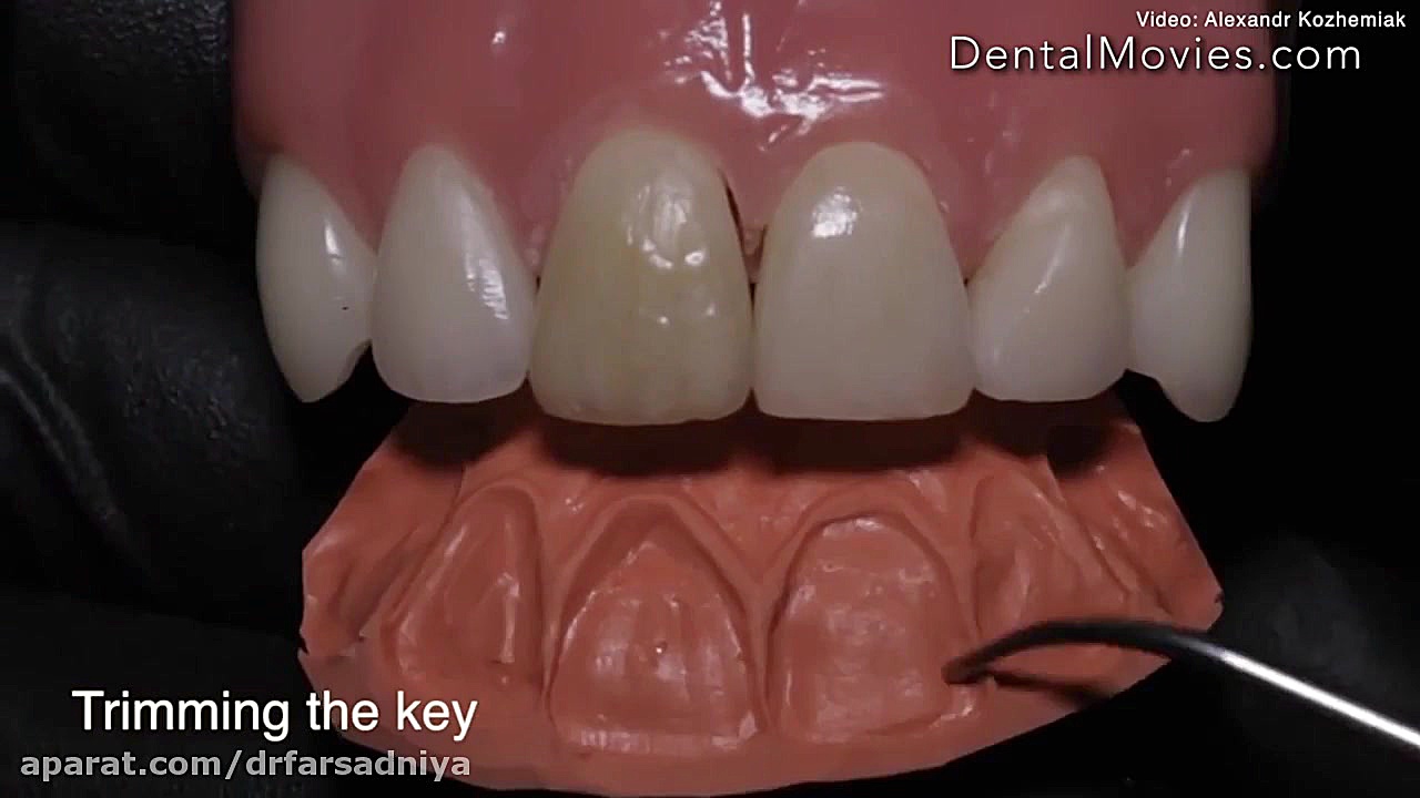 ویدئو ترمیم دندان جلو دکتر فروزان فرسادنیا www.drfarsadniya.ir