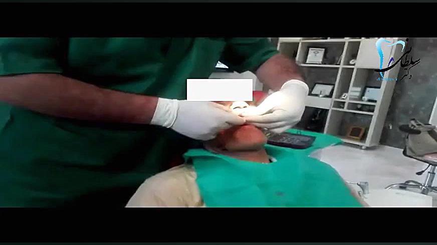 كاشت ایمپلنت در تبریز دکتر جمال سلطانی دندانپزشک خوب در تبریز