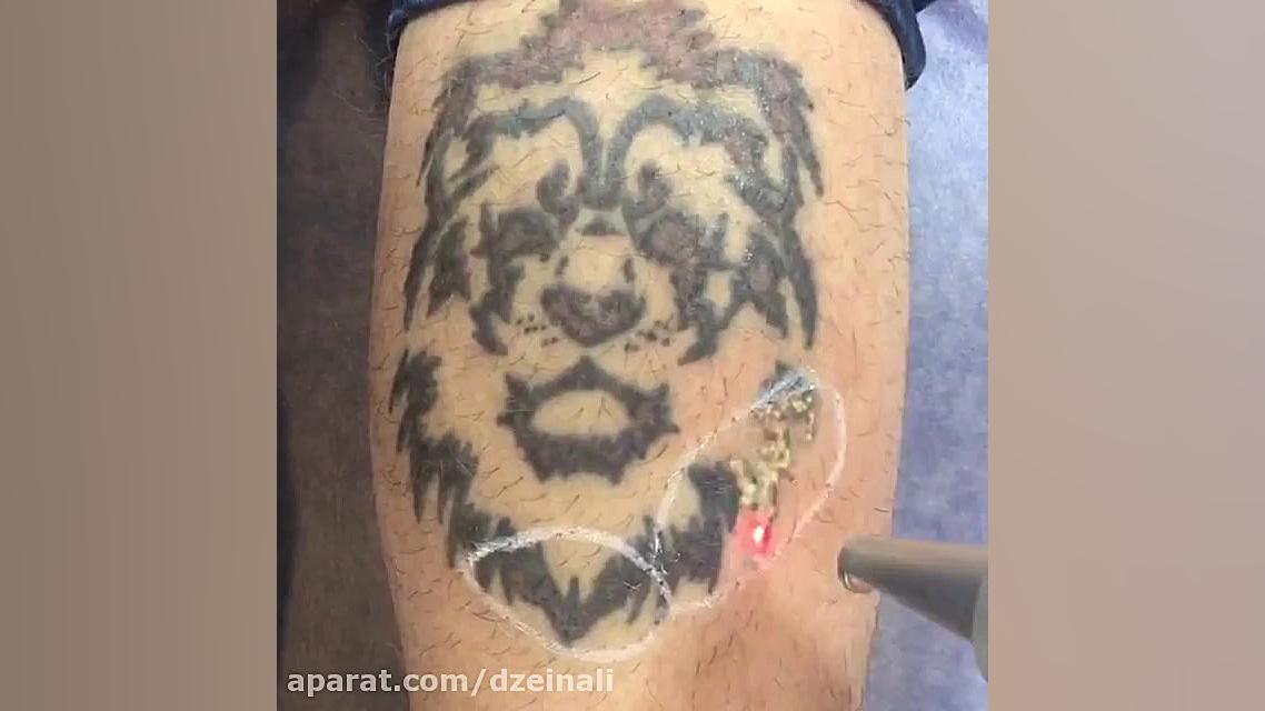 رفع دائمی تاتو و خالكوبی بدن وصورت با پیشرفته ترین لیزر دکتر فرحناز زینعلی - متخصص پوست، مو، زیبایی زنجان