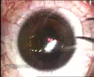 جراحی لیزیک چشم PVRژنتیک پزشکی پیشرفته