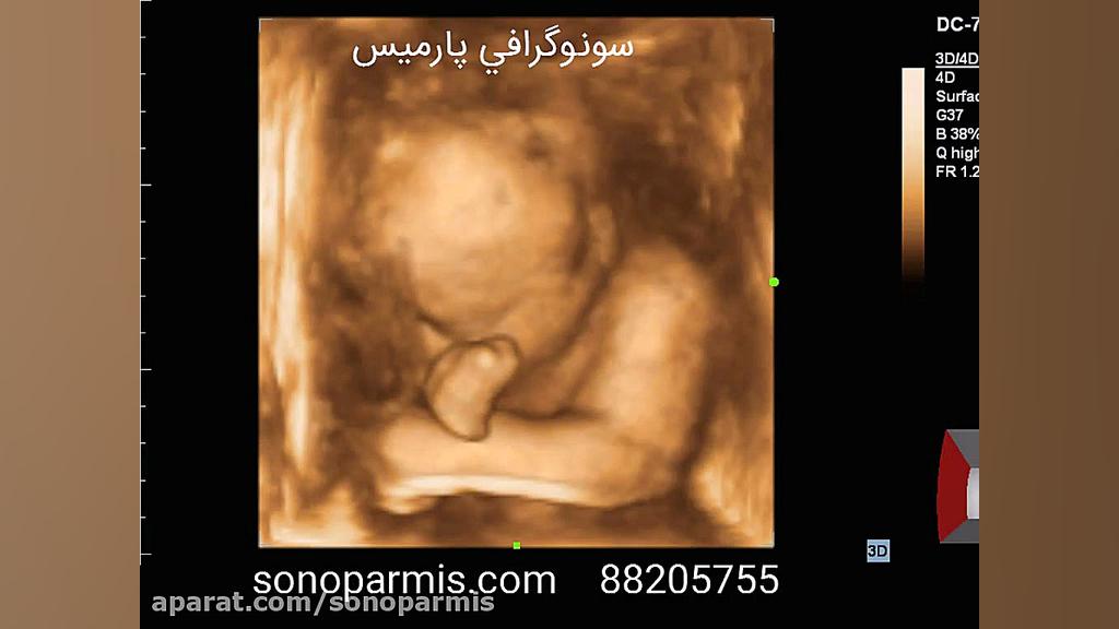 سونوگرافی سه بعدی جنین لیپوساکشن