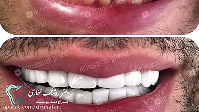 زیبایی دندان هیدروراکس