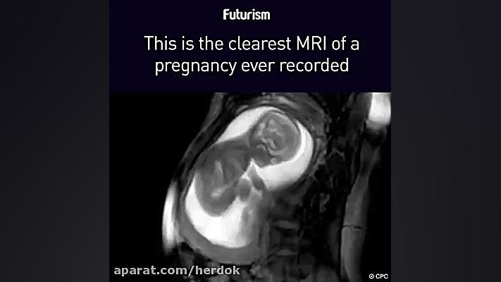 واضحترین تصاویر MRI از جنین هایفوتراپی