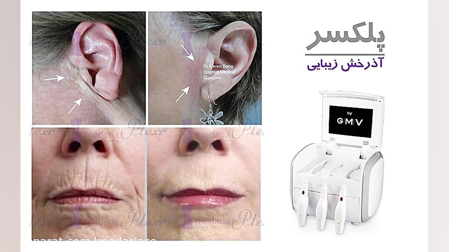 پلکسر لیزر فرکشنال