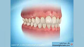 نحوه عملکرد پلاک های نامرئی-دکتر سعید قریشی دکتر سعید قریشی