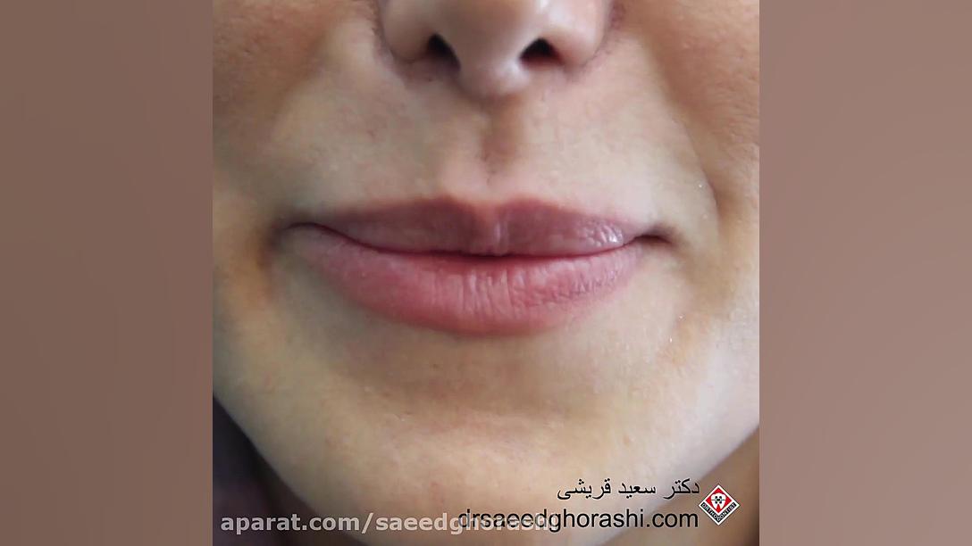 یک مورد بیمار با پلاک نامرئی-دکتر سعید قریشی دکتر سعید قریشی