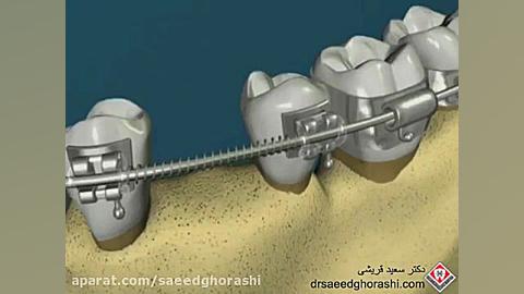 درمان فضا خالی بین دندانی با ارتودنسی-دکتر سعید قریشی دکتر سعید قریشی