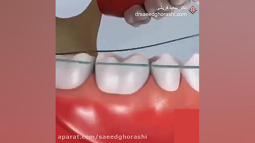 نخ دندان- دکتر سعید قریشی دکتر سعید قریشی