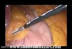 اسلیو گاسترکتومی جهت لاغری(دکت...