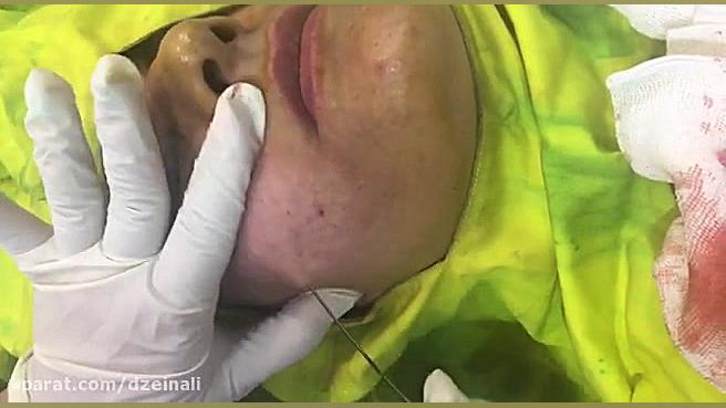 انجام ساب سیژن برای رفع دائمی اسكارهای آتروفیك آكنه دکتر فرحناز زینعلی - متخصص پوست، مو، زیبایی زنجان