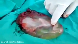 جنین زنده در کیسه آب!