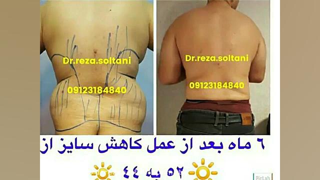 لیپوماتیک کمر و پهلو زاویه سازی صورت