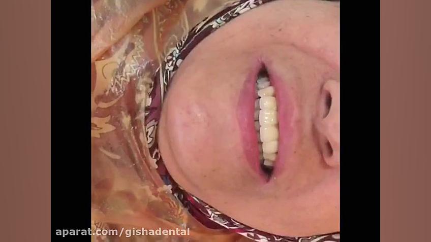 جایگزینی دندانهای جلویی با ایمپلنت کلینیک دندانپزشکی دکتر عزیز گشاده رو