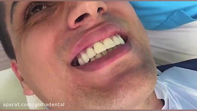 روكش تمام سرامیك متكی بر ایمپلنت و لامینیت برای دندانها کلینیک دندانپزشکی دکتر عزیز گشاده رو