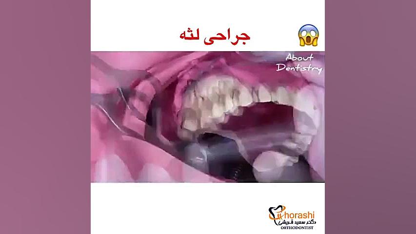 جراحی لثه-دکتر سعید قریشی TAVI
