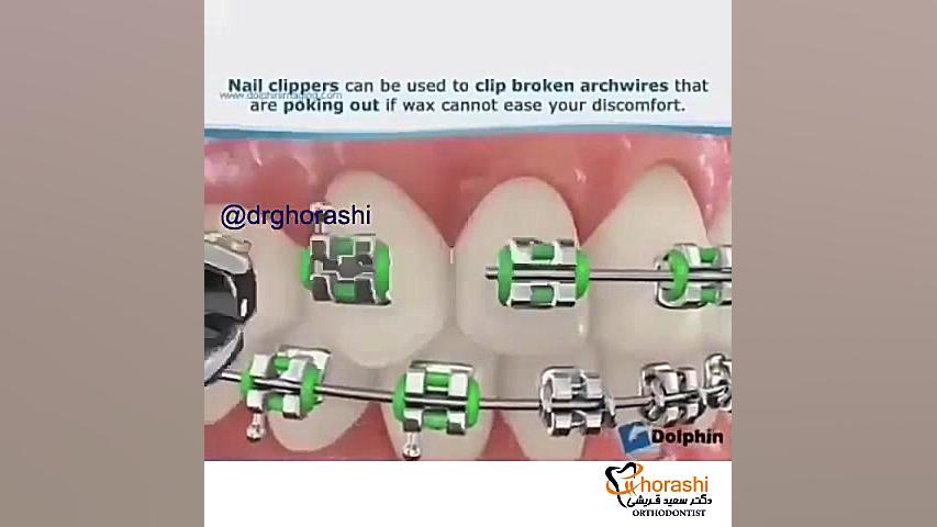 موم و وکس در ارتودنسی-دکتر سعید قریشی دکتر سعید قریشی