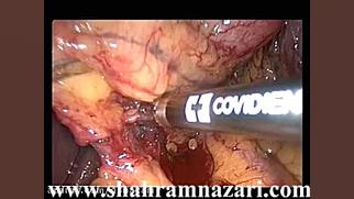 برداشتن لاپاروسکوپی کامل معده در سرطان معده رفع افتادگی پلک