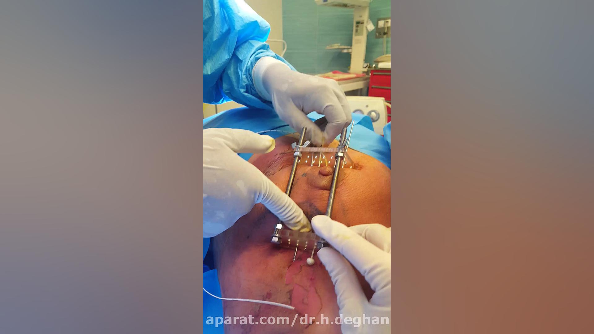 براکی تراپی سرطان پستان دکتر حمیدرضا دهقان منشادی