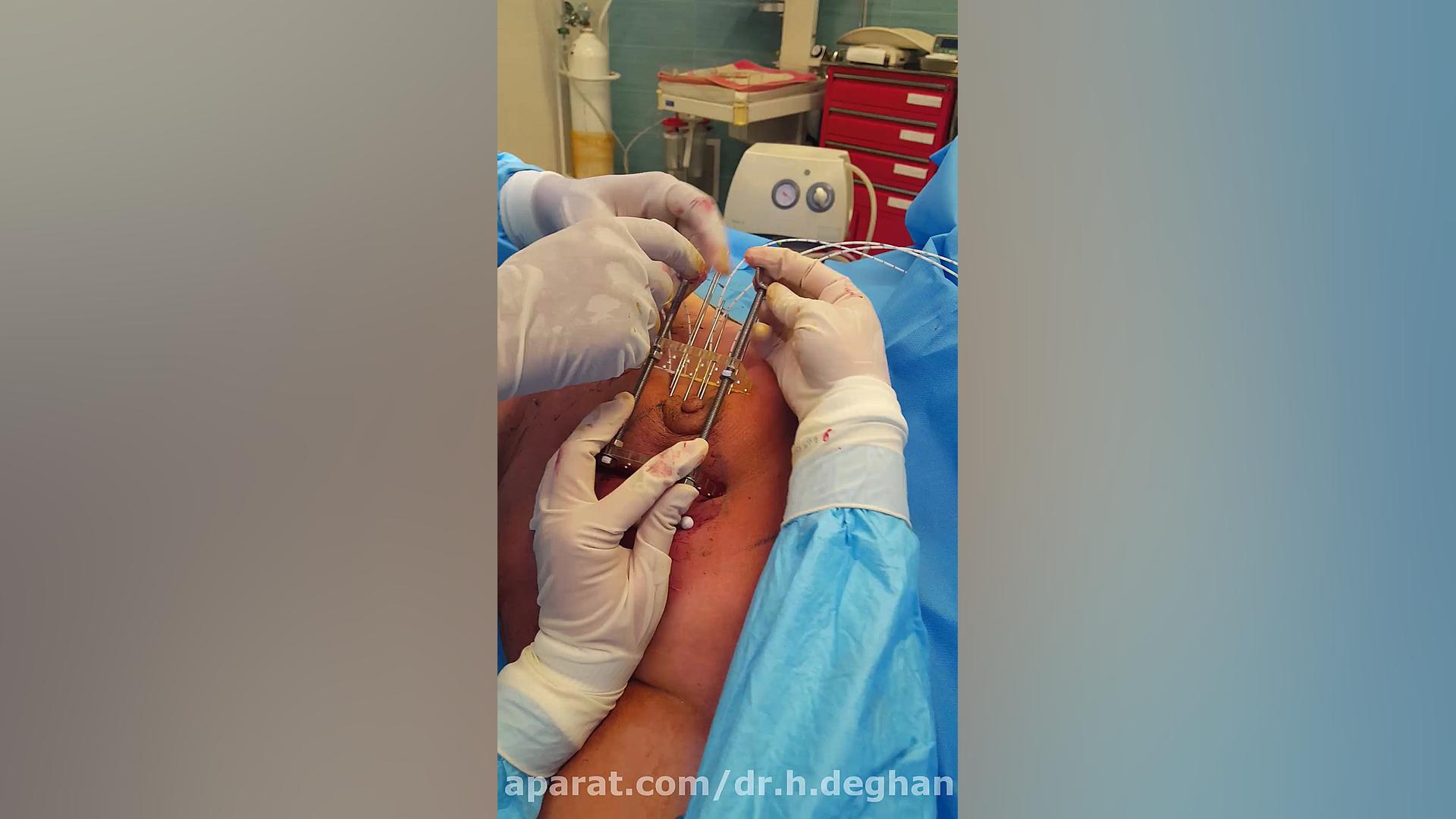 کاشت براکی تراپی پستان دکتر حمیدرضا دهقان منشادی