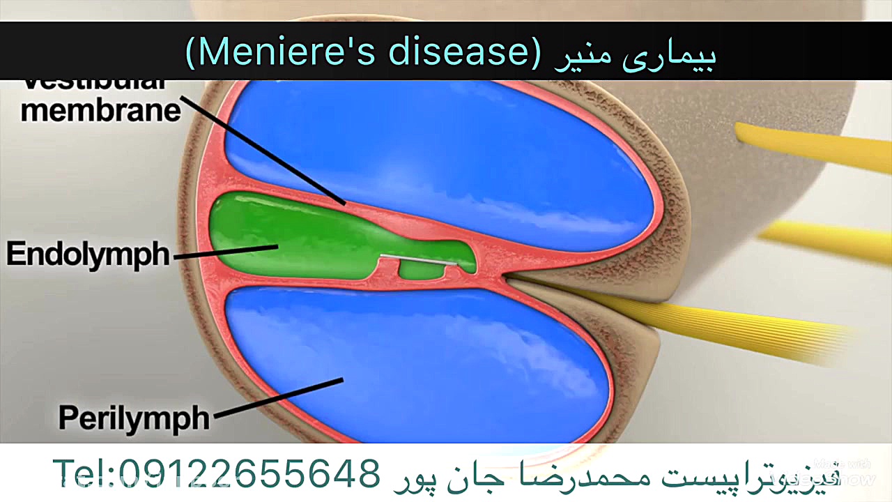 بیماری منیر (Meniere's disease). مشاورهtel:09122655648 ترمیم دندان