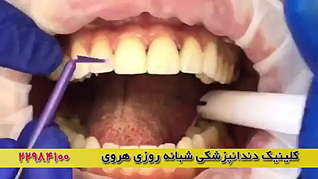 زیبایی با ونیر دندان لیزر فرکشنال