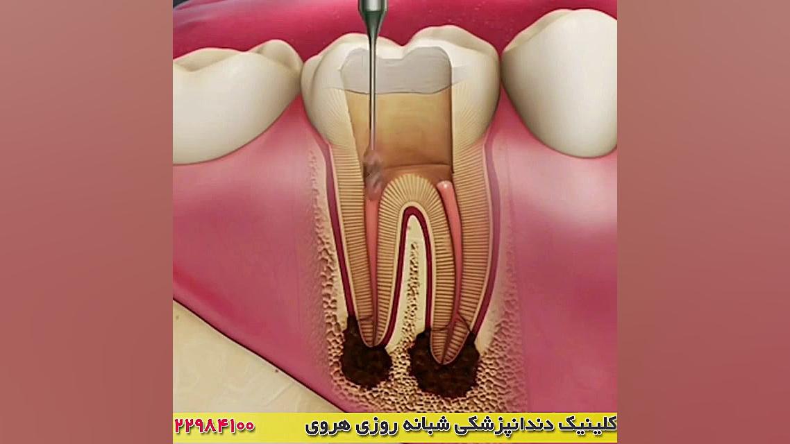 فیلم ترمیم و پر کردن دندان بیماری آسپارتیل گلوکوزامینوریا