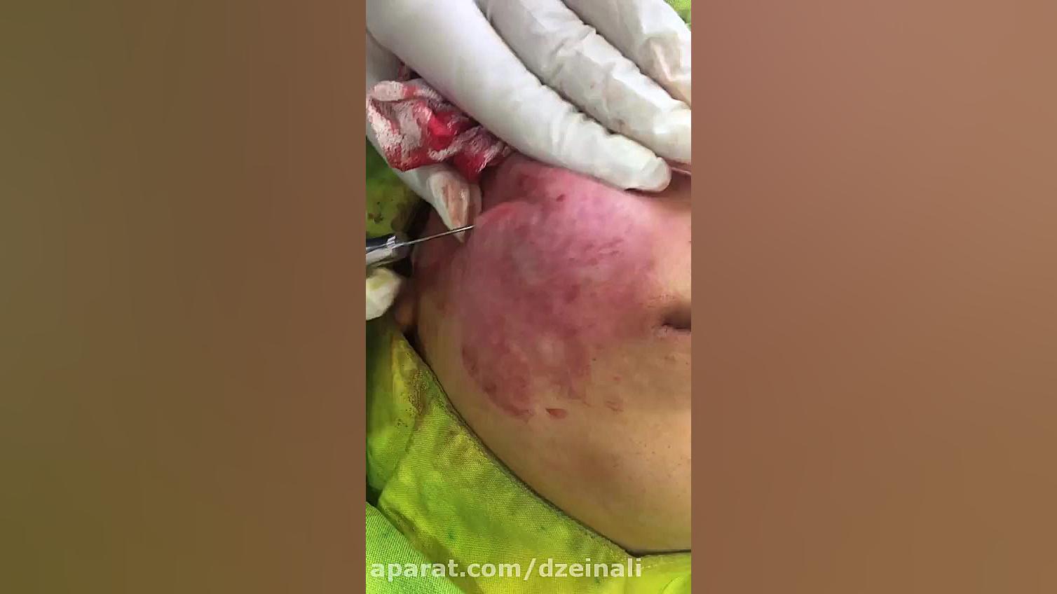 انجام ساب سیژن برای رفع دائمی اسكارهای آكنه دکتر فرحناز زینعلی - متخصص پوست، مو، زیبایی زنجان