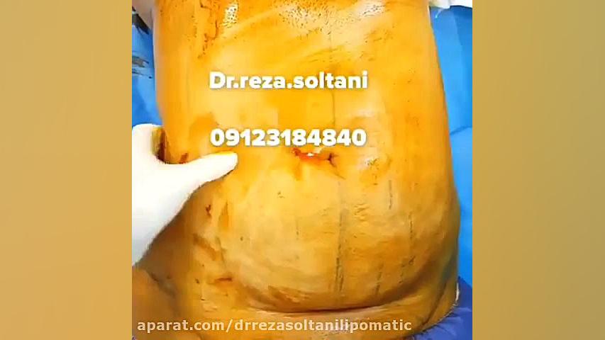 لیپوماتیک شکم و پهلو دکتر رضا سلطانی