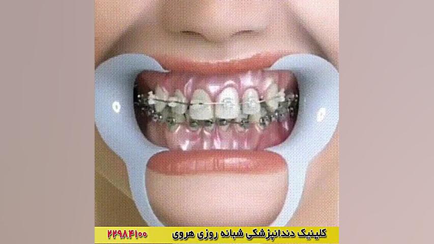 فیلم ارتودنسی دندان | ارتودنسی ثابت دندان ایوانبرادین