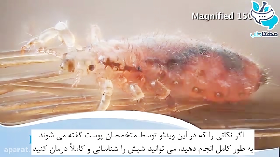 شناسایی و درمان شپش سر