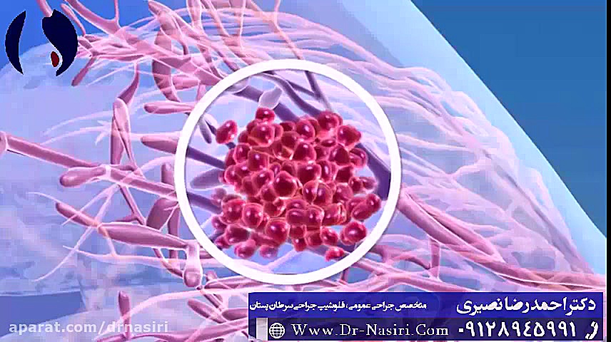علائم سرطان سینه دکتر احمدرضا نصیری