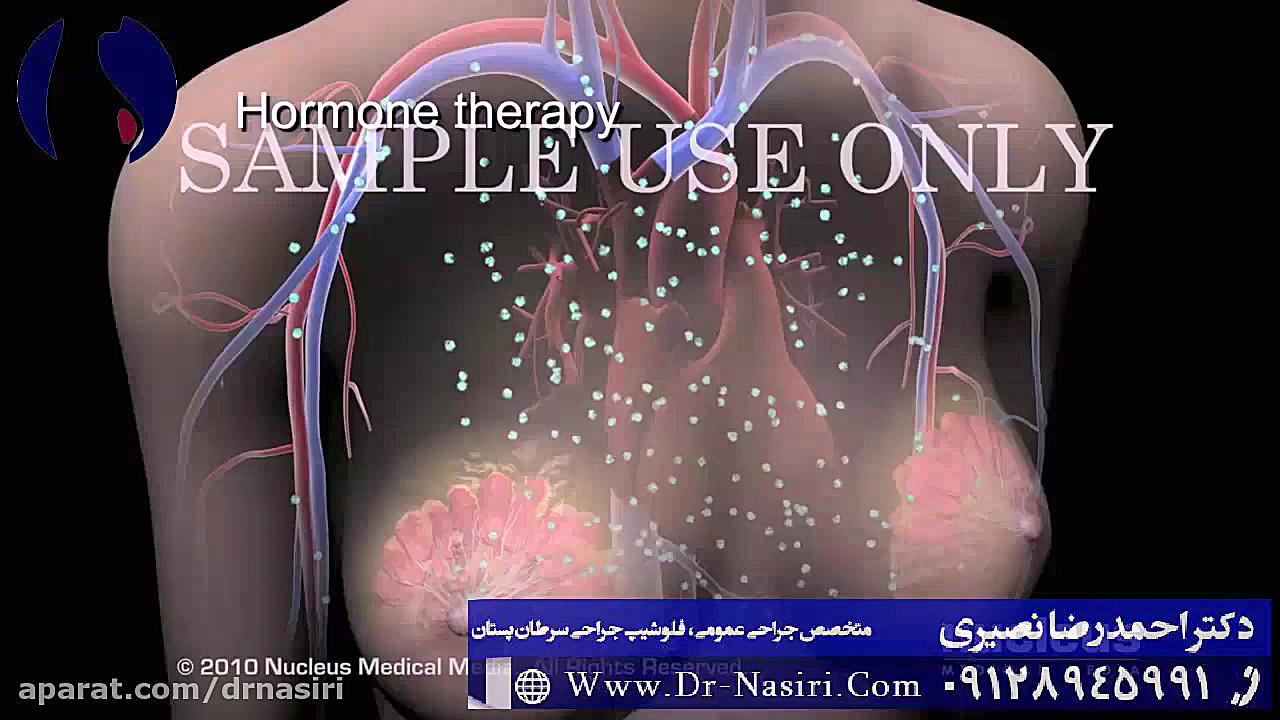 سرطان سینه دکتر احمدرضا نصیری