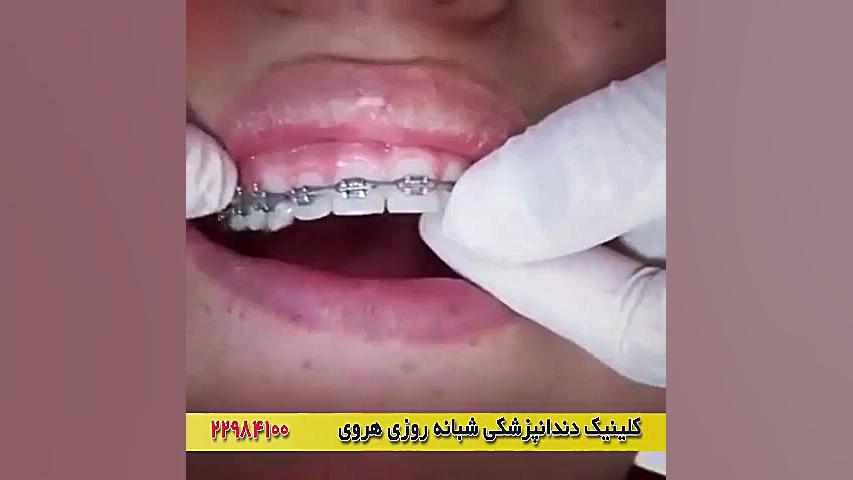 فیلم ارتودنسی (سیم کشی) دندان فرمانزوماب