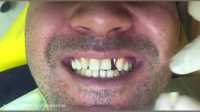 یک واحد ایمپلنت با روكش تمام سرامیک کلینیک دندانپزشکی دکتر عزیز گشاده رو