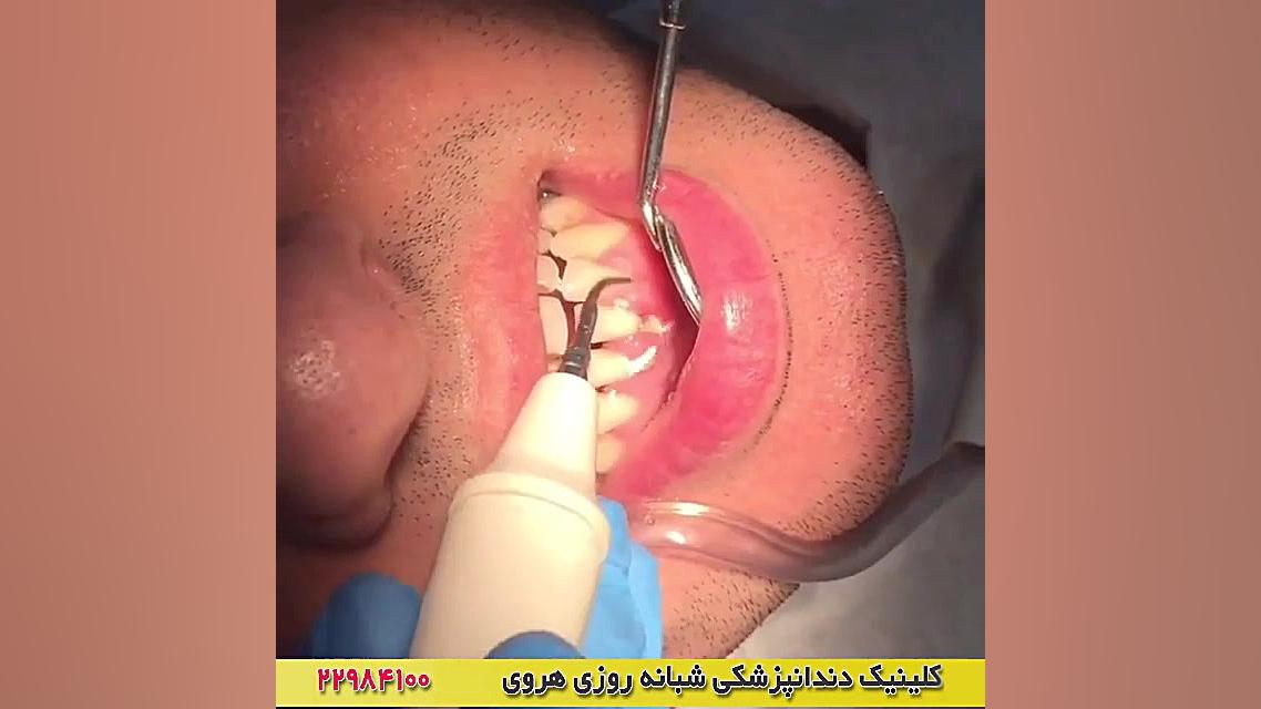 فیلم واقعی از بلیچینگ و جرمگیری دندان ها در دندانپزشکی جراحی فک