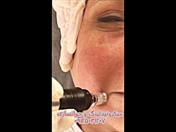 جوانسازی به روش میکرونیدلینگ