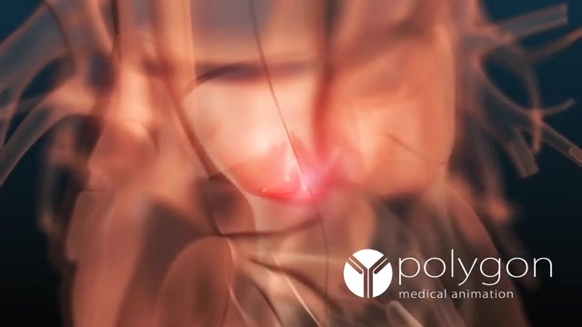 P15- TAVI-Transcatheter Aortic Valve Implantation سنداکتیلی