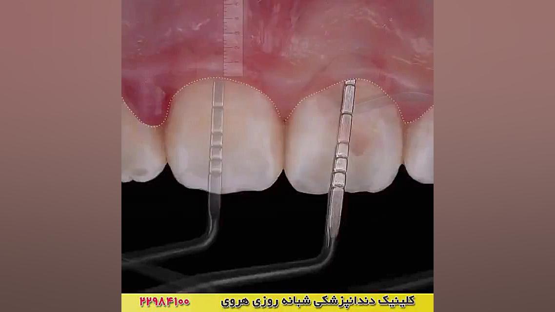 درمان و اصلاح لبخند لثه ای | جراحی زیبایی لثه قارچ‌شناسی پزشکی